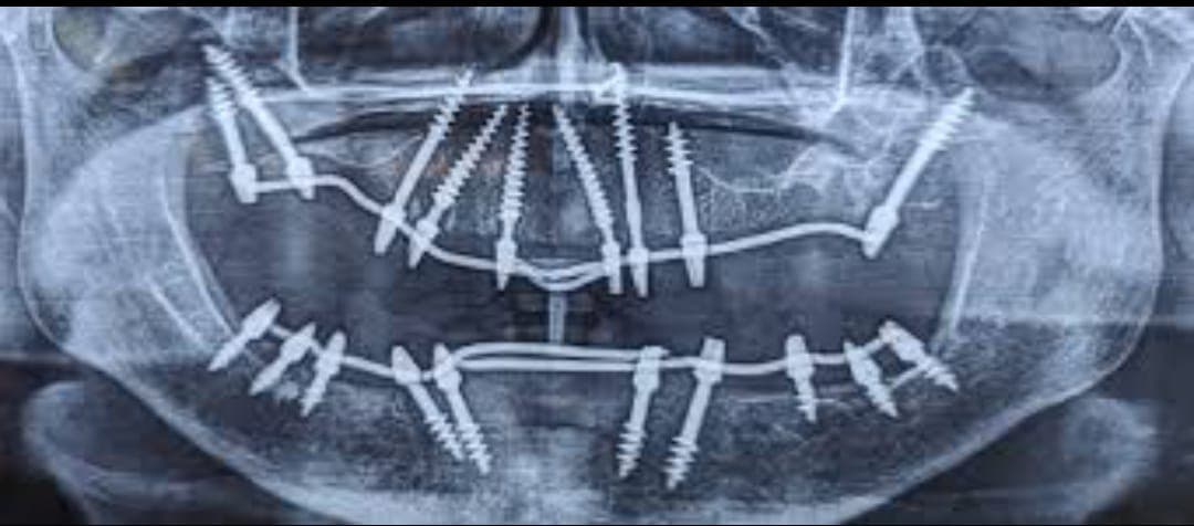 Patient smiling after a successful dental procedure.